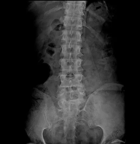 Radiografía lateral de cuello